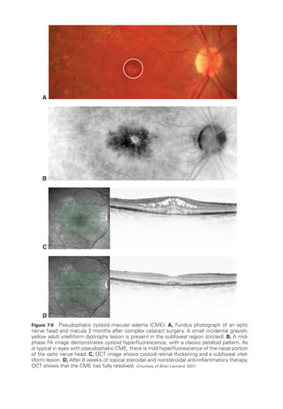 A
B
C
D
Figure 7-9 Pseudophakic cystoid macular edema (CME). A, Fundus photo­
graph of an optic
nerve head and macula 3 months ­
after complex cataract surgery. A small incidental grayish-­
yellow adult vitelliform dystrophy lesion is pre­
sent in the subfoveal region (circled). B, A mid-­
phase FA image demonstrates cystoid hyperfluorescence, with a classic petaloid pattern. As
is typical in eyes with pseudophakic CME, ­
there is mild hyperfluorescence of the nasal portion
of the optic nerve head. C, OCT image shows cystoid ret­
i­
nal thickening and a subfoveal vitel-
liform lesion. D, ­
After 8 weeks of topical ste­
roidal and nonsteroidal anti-­
inflammatory therapy,
OCT shows that the CME has fully resolved. (Courtesy of Brian Leonard, MD.)
 