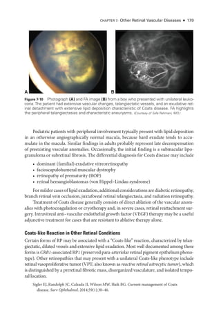 Pediatric patients with peripheral involvement typically pre­
sent with lipid deposition
in an other­
wise angiographically normal macula, ­
because hard exudate tends to accu-
mulate in the macula. Similar findings in adults prob­
ably represent late decompensation
of preexisting vascular anomalies. Occasionally, the initial finding is a submacular lipo-
granuloma or subret­
i­
nal fibrosis. The differential diagnosis for Coats disease may include
• dominant (familial) exudative vitreoretinopathy
• facioscapulohumeral muscular dystrophy
• retinopathy of prematurity (ROP)
• ret­
i­
nal hemangioblastomas (von Hippel–­
Lindau syndrome)
For milder cases of lipid exudation, additional considerations are diabetic retinopathy,
branch ret­
i­
nal vein occlusion, juxtafoveal ret­
i­
nal telangiectasia, and radiation retinopathy.
Treatment of Coats disease generally consists of direct ablation of the vascular anom-
alies with photocoagulation or cryotherapy and, in severe cases, ret­
i­
nal reattachment sur-
gery. Intravitreal anti–­
vascular endothelial growth ­
factor (VEGF) therapy may be a useful
adjunctive treatment for cases that are resistant to ablative therapy alone.
Coats-­
like Reaction in Other Ret­
i­
nal Conditions
Certain forms of RP may be associated with a “Coats-­
like” reaction, characterized by telan-
giectatic, dilated vessels and extensive lipid exudation. Most well documented among ­
these
forms is CRB1-­associated RP1 (preserved para-­arteriolar ret­i­nal pigment epithelium pheno-
type). Other retinopathies that may pre­
sent with a unilateral Coats-­
like phenotype include
ret­
i­
nal vasoproliferative tumor (VPT; also known as reactive ret­
i­
nal astrocytic tumor), which
is distinguished by a preret­
i­
nal fibrotic mass, disor­
ga­
nized vasculature, and isolated tempo-
ral location.
Sigler EJ, Randolph JC, Calzada JI, Wilson MW, Haik BG. Current management of Coats
disease. Surv Ophthalmol. 2014;59(1):30–46.
A B
Figure 7-10 Photo­graph (A) and FA image (B) from a boy who presented with unilateral leuko-
coria.The patient had extensive vascular changes, telangiectatic vessels, and an exudative ret­
i­
nal detachment with extensive lipid deposition characteristic of Coats disease. FA highlights
the peripheral telangiectasias and characteristic aneurysms. (Courtesy of Safa Rahmani, MD.)
CHAPTER 7: Other Ret­i­nal Vascular Diseases ● 179
 