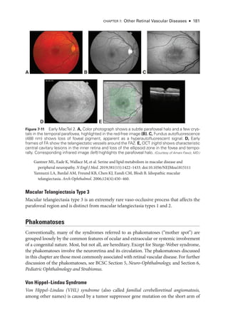 Gantner ML, Eade K, Wallace M, et al. Serine and lipid metabolism in macular disease and
peripheral neuropathy. N Engl J Med. 2019;381(15):1422–1433. doi:10.1056/NEJMoa1815111
Yannuzzi LA, Bardal AM, Freund KB, Chen KJ, Eandi CM, Blodi B. Idiopathic macular
telangiectasia. Arch Ophthalmol. 2006;124(4):450–460.
Macular Telangiectasia Type 3
Macular telangiectasia type 3 is an extremely rare vaso-occlusive pro­
cess that affects the
parafoveal region and is distinct from macular telangiectasia types 1 and 2.
Phakomatoses
Conventionally, many of the syndromes referred to as phakomatoses (“­
mother spot”) are
grouped loosely by the common features of ocular and extraocular or systemic involvement
of a congenital nature. Most, but not all, are hereditary. Except for Sturge-­
Weber syndrome,
the phakomatoses involve the neuroret­
ina and its circulation. The phakomatoses discussed
in this chapter are ­
those most commonly associated with ret­
i­
nal vascular disease. For further
discussion of the phakomatoses, see BCSC Section 5, Neuro-­Ophthalmology, and Section 6,
Pediatric Ophthalmology and Strabismus.
Von Hippel–­
Lindau Syndrome
Von Hippel–­
Lindau (VHL) syndrome (also called familial cerebelloret­i­nal angiomatosis,
among other names) is caused by a tumor suppressor gene mutation on the short arm of
A B C
D E
Figure 7-11 Early MacTel 2. A, Color photo­
graph shows a subtle parafoveal halo and a few crys-
tals in the temporal parafovea, highlighted in the red-­
free image (B). C, Fundus autofluorescence
(488 nm) shows loss of foveal pigment, apparent as a hyperautofluorescent signal. D, Early
frames of FA show the telangiectatic vessels around the FAZ. E, OCT (right) shows characteristic
central cavitary lesions in the inner ret­
ina and loss of the ellipsoid zone in the fovea and tempo-
rally. Corresponding infrared image (left) highlights the parafoveal halo. (Courtesy of Amani Fawzi, MD.)
CHAPTER 7: Other Ret­i­nal Vascular Diseases ● 181
 