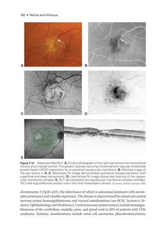 182 ● Retina and Vitreous
chromosome 3 (3p26–­
p25), the inheritance of which is autosomal dominant with incom-
plete penetrance and variable expression. The disease is characterized by ret­i­nal and central
ner­
vous system hemangioblastomas and visceral manifestations (see BCSC Section 6, Pe­
diatric Ophthalmology and Strabismus). Central ner­vous system tumors include hemangio-
blastomas of the cerebellum, medulla, pons, and spinal cord in 20% of patients with VHL
syndrome. Systemic manifestations include renal cell carcinoma; pheochromocytomas;
A B
D
C
E
Figure 7-12 Advanced MacTel 2. A, Fundus photo­
graph of the right eye shows the chorioret­
i­
nal
venous shunt vessel (arrow).This patient receives recurring intravitreal anti–­
vascular endothelial
growth ­
factor (VEGF) treatments for a subret­
i­
nal neovascular membrane. B, Red-­
free image of
the eye shown in A. C, Mid-­
phase FA image demonstrates subret­
i­
nal neovascularization with
superficial and deep components. D, Later-­
phase FA image shows late staining of the neovas-
cular membrane complex. E, OCT demonstrates the neovascular membrane complex and Mac-
Tel 2–­
like hyporeflective cavities within the inner foveal layers (arrow). (Courtesy of Brian Leonard, MD.)
 