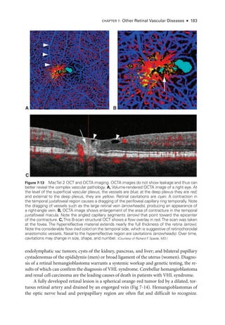 endolymphatic sac tumors; cysts of the kidney, pancreas, and liver; and bilateral papillary
cystadenomas of the epididymis (men) or broad ligament of the uterus (­
women). Diagno-
sis of a ret­
i­
nal hemangioblastoma warrants a systemic workup and ge­
ne­
tic testing, the re-
sults of which can confirm the diagnosis of VHL syndrome. Cerebellar hemangioblastoma
and renal cell carcinoma are the leading ­
causes of death in patients with VHL syndrome.
A fully developed ret­
i­
nal lesion is a ­
spherical orange-­
red tumor fed by a dilated, tor-
tuous ret­
i­
nal artery and drained by an engorged vein (Fig 7-14). Hemangioblastomas of
the optic nerve head and peripapillary region are often flat and difficult to recognize.
A B
C
Figure 7-13 MacTel 2 OCT and OCTA imaging. OCTA images do not show leakage and thus can
better reveal the complex vascular pathology. A, Volume-­
rendered OCTA image of a right eye. At
the level of the superficial vascular plexus, the vessels are blue; at the deep plexus they are red;
and external to the deep plexus, they are yellow. Ret­
i­
nal cavitations are cyan. A contraction in
the temporal juxtafoveal region ­
causes a dragging of the perifoveal capillary ring temporally. Note
the dragging of vessels such as the large ret­
i­
nal vein (arrowheads), producing an appearance of
a right-­
angle vein. B, OCTA image shows enlargement of the area of contracture in the temporal
juxtafoveal macula. Note the angled capillary segments (arrow) that point ­
toward the epicenter
of the contracture. C,This B-­
scan structural OCT shows a flow overlay in red.The scan was taken
at the fovea. The hyperreflective material extends nearly the full thickness of the ret­
ina (arrow).
Note the considerable flow (red color) on the temporal side, which is suggestive of retinochoroidal
anastomotic vessels. Nasal to the hyperreflective region are cavitations (arrowheads). Over time,
cavitations may change in size, shape, and number. (Courtesy of Richard F
. Spaide, MD.)
CHAPTER 7: Other Ret­i­nal Vascular Diseases ● 183
 