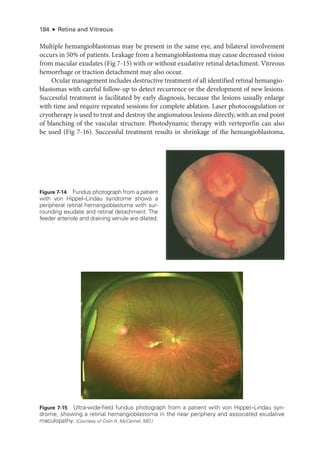 184 ● Retina and Vitreous
Multiple hemangioblastomas may be pre­
sent in the same eye, and bilateral involvement
occurs in 50% of patients. Leakage from a hemangioblastoma may cause decreased vision
from macular exudates (Fig 7-15) with or without exudative ret­
i­
nal detachment. Vitreous
hemorrhage or traction detachment may also occur.
Ocular management includes destructive treatment of all identified ret­
i­
nal hemangio-
blastomas with careful follow-up to detect recurrence or the development of new lesions.
Successful treatment is facilitated by early diagnosis, ­
because the lesions usually enlarge
with time and require repeated sessions for complete ablation. ­
Laser photocoagulation or
cryotherapy is used to treat and destroy the angiomatous lesions directly, with an end point
of blanching of the vascular structure. Photodynamic therapy with verteporfin can also
be used (Fig 7-16). Successful treatment results in shrinkage of the hemangioblastoma,
Figure 7-14 Fundus photo­
graph from a patient
with von Hippel–­
Lindau syndrome shows a
peripheral ret­
i­
nal hemangioblastoma with sur-
rounding exudate and ret­
i­
nal detachment. The
feeder arteriole and draining venule are dilated.
Figure 7-15 Ultra-­
wide-­
field fundus photo­
graph from a patient with von Hippel–­
Lindau syn-
drome, showing a ret­
i­
nal hemangioblastoma in the near periphery and associated exudative
maculopathy. (Courtesy of Colin A. McCannel, MD.)
 