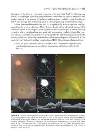 attenuation of the afferent vessels, and resorption of the subret­
i­
nal fluid. Cryotherapy may
be used to treat larger, especially more peripheral, lesions but can cause a temporary and
marked increase in the amount of exudation and sometimes exudative ret­
i­
nal detachment.
Anti-­
VEGF therapy does not usually result in a meaningful, long-­
term treatment effect.
Ret­
i­
nal hemangioblastomas may also occur sporadically without systemic involve-
ment; ­
these have been called von Hippel lesions. Another form of ret­
i­
nal lesions, VPTs
(discussed ­
earlier in the chapter), are thought to be reactive astrocytic in nature and may
pre­
sent as a large peripheral vascular mass with surrounding exudation/Coats-­
like reac-
tion. ­
These acquired lesions do not have the dilated feeder and draining vessels seen with
hemangioblastomas. Generally, vasoproliferative lesions are idiopathic and isolated; in rare
cases, they may be pre­
sent as a late complication of ROP, RP, uveitis, or other conditions.
Gaudric A, Krivosic V, Duquid G, Massin P, Giraud S, Richard S. Vitreoret­
i­
nal surgery for severe
ret­
i­
nal capillary hemangiomas in von Hippel–­
Lindau disease. Ophthalmology. 2011;118(1):​
142–149.
A B D
E F G
C
Figure 7-16 Retinal hemangioblastoma (RH). A, Classic appearance with dilated feeder vessels,
along with hard exudates. Note the large area of fluid in the macula. Classic early-phase (B) and
late-phase (C) FA images showing RH leakage. D, Appearance of this tumor ­
after a single photo-
dynamic therapy (PDT) session. Note that the vessel caliber and tortuosity normalize ­
after treat-
ment. E, OCT of the tumor itself (inset depicts the location of the OCT slice). F, Intraret­i­nal and
subret­
i­
nal fluid in the macula at pre­
sen­
ta­
tion. G, Resorption of the fluid following PDT. (Courtesy of
Anthony B. Daniels, MD, MSc.)
CHAPTER 7: Other Ret­i­nal Vascular Diseases ● 185
 