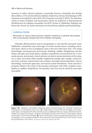 188 ● Retina and Vitreous
necessary to induce clinical symptoms; occasionally, however, retinopathy may develop
­after as ­little as 15 Gy of external beam radiation. Studies have shown ret­i­nal damage in 50%
of patients receiving 60 Gy and in 85%–95% of patients receiving 70–80 Gy. The total dose,
volume of ret­
ina irradiated, and fractionation scheme are impor­
tant in determining the
threshold dose for radiation retinopathy. See BCSC Section 4, Ophthalmic Pathology and
Intraocular Tumors, for further discussion of external beam radiation and brachytherapy.
CLINICAL PEARL
Remember to inquire about previous radiation treatment in patients who pre­
sent
with microvascular changes that mimic diabetic retinopathy.
Clinically, affected patients may be asymptomatic or may describe decreased vision.
Ophthalmic examination may reveal signs of ret­
i­
nal vascular disease, including cotton-­
wool spots, which are foci of axoplasmic stasis in the nerve fiber layer (Fig 7-19); ret­
i­
nal
hemorrhages; microaneurysms; perivascular sheathing; capillary telangiectasis; macular
edema; and optic nerve head edema. Capillary nonperfusion, documented by FA, is com-
monly pre­
sent, and extensive ret­
i­
nal ischemia can lead to neovascularization of the ret­
ina,
iris, or optic nerve head. Other pos­
si­
ble complications include optic atrophy, central ret­
i­
nal artery occlusion, central ret­
i­
nal vein occlusion, choroidal neovascularization, vitreous
hemorrhage, neovascular glaucoma, and traction ret­
i­
nal detachment. Visual outcome is
primarily related to the extent of the macular involvement with CME, exudative macu-
lopathy, or capillary nonperfusion. Occasionally, vision loss may be caused by acute optic
neuropathy.
A B
Figure 7-19 Radiation retinopathy following plaque brachytherapy for choroidal melanoma.
Progression of retinopathy over time. A, Image shows intraret­
i­
nal hemorrhages and cotton-­
wool spots. Compared with other entities (such as diabetes) that can cause intraret­
i­
nal hemor-
rhages and cotton-­
wool spots, radiation retinopathy ­
causes many more of ­
these spots relative
to the extent of the hemorrhages. B, Eight months ­
later, ­
there is substantial progression of the
retinopathy, with increased exudation and subret­
i­
nal and intraret­
i­
nal fluid in the macula. Visual
acuity declined in the interim. (Courtesy of Anthony B. Daniels, MD, MSc.)
 