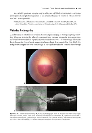 Anti-­
VEGF agents or ste­
roids may be effective (off-­
label) treatments for radiation
retinopathy. ­
Laser photocoagulation is less effective ­
because it results in ret­
i­
nal atrophy
and ­
laser scar expansion.
Patel SJ, Schachat AP. Radiation retinopathy. In: Albert DM, Miller JW, Azar DT, Blodi BA, eds.
Albert  Jakobiec’s Princi­
ples and Practice of Ophthalmology. 3rd ed. Saunders; 2008:​
chap 175.
Valsalva Retinopathy
A sudden rise in intrathoracic or intra-­
abdominal pressure (eg, as during coughing, vomit-
ing, lifting, or straining for a bowel movement) may increase intraocular venous pressure
sufficiently to rupture small superficial capillaries in the macula. The hemorrhage is typically
located ­
under the ILM, where it may create a hemorrhagic detachment of the ILM (Fig 7-20),
but patients can pre­
sent with hemorrhage in any layer of the ret­
ina. Vitreous hemorrhage
CHAPTER 7: Other Ret­i­nal Vascular Diseases ● 189
A
B
Figure 7-20 Valsalva retinopathy. A, Fundus photo­
graph from a 30-­
year-­
old man who expe-
rienced sudden vision loss ­
after receiving the Heimlich maneuver. B, Spectral-­
domain OCT
demonstrates classic hemorrhagic detachment of the internal limiting membrane with corre-
sponding shadowing effect. (Courtesy of Kenneth Taubenslag, MD, and Edward Cherney, MD.)
 