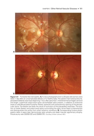 A
B
*
Figure 7-21 Purtscher-­like retinopathy. A, Fundus photo­
graphs from a 20-­
year-­
old ­
woman ­
were
taken 1 day ­
after an uncomplicated delivery of a healthy baby.The patient had noted profound,
per­
sis­
tent bilateral vision loss beginning 1 hour ­
after parturition. Intraret­
i­
nal hemorrhages (arrows)
and bright, superficial cotton-­
wool spots (arrowheads) ­
were pre­
sent, in addition to extensive
areas of well-­
demarcated Purtscher flecken (asterisk) with characteristic sparing of the perivas-
cular ret­
ina.The flecken are likely the result of occlusion of the precapillary arterioles.The loca-
tion of ­
these flecken and cotton-­
wool spots surrounding the optic nerve head is characteristic
and distinguishes this entity from other ischemic conditions. B, Corresponding fundus photo­
graphs taken 4 years ­
later demonstrate optic atrophy and deep macular pigmentary atrophy.
Visual acuity was 20/200 OD and 20/800 OS. (Courtesy of Brian Leonard, MD.)
CHAPTER 7: Other Ret­i­nal Vascular Diseases ● 191
 