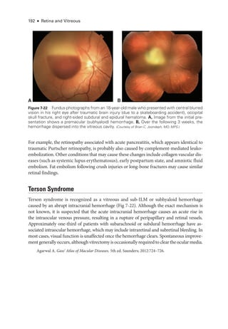 192 ● Retina and Vitreous
A B
Figure 7-22 Fundus photo­
graphs from an 18-­
year-­
old male who presented with central blurred
vision in his right eye ­
after traumatic brain injury (due to a skateboarding accident), occipital
skull fracture, and right-­
sided subdural and epidural hematoma. A, Image from the initial pre­
sen­
ta­
tion shows a premacular (subhyaloid) hemorrhage. B, Over the following 3 weeks, the
hemorrhage dispersed into the vitreous cavity. (Courtesy of Brian C. Joondeph, MD, MPS.)
For example, the retinopathy associated with acute pancreatitis, which appears identical to
traumatic Purtscher retinopathy, is prob­
ably also caused by complement-­
mediated leuko-
embolization. Other conditions that may cause ­
these changes include collagen vascular dis-
eases (such as systemic lupus erythematosus), early postpartum state, and amniotic fluid
embolism. Fat embolism following crush injuries or long-­
bone fractures may cause similar
ret­i­nal findings.
Terson Syndrome
Terson syndrome is recognized as a vitreous and sub-­
ILM or subhyaloid hemorrhage
caused by an abrupt intracranial hemorrhage (Fig 7-22). Although the exact mechanism is
not known, it is suspected that the acute intracranial hemorrhage ­
causes an acute rise in
the intraocular venous pressure, resulting in a rupture of peripapillary and ret­
i­
nal vessels.
Approximately one-­
third of patients with subarachnoid or subdural hemorrhage have as-
sociated intraocular hemorrhage, which may include intraret­
i­
nal and subret­
i­
nal bleeding. In
most cases, visual function is unaffected once the hemorrhage clears. Spontaneous improve-
ment generally occurs, although vitrectomy is occasionally required to clear the ocular media.
Agarwal A. Gass’ Atlas of Macular Diseases. 5th ed. Saunders; 2012:724–726.
 