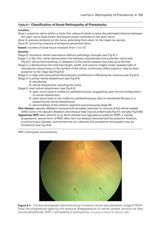 CHAPTER 8: Retinopathy of Prematurity ● 195
­Table 8-1 ​
Classification of Acute Retinopathy of Prematurity
Location
Zone I: posterior ret­
ina within a circle (the radius of which is twice the estimated distance between
the optic nerve head center and foveal center) centered on the optic nerve
Zone II: annulus centered on the nerve extending from zone I to the nasal ora serrata
Zone III: remaining crescent of temporal peripheral ret­
ina
Extent: number of clock-­
hours involved (from 1 to 12)
Severity
Stage 0: immature ret­
i­
nal vasculature without pathologic changes (see Fig 8-1)
Stage 1: a flat, thin, white demarcation line between vascularized and avascular ret­
ina (see
Fig 8-2); abnormal branching or dilatation of the ret­
i­
nal vessels may lead up to the line
Stage 2: a demarcation line that has height, width, and volume (ridge); small, isolated tufts of
neovascular tissue lying on the surface of the ret­
ina, commonly called popcorn, may be seen
posterior to the ridge (see Fig 8-3)
Stage 3: a ridge with extraret­
i­
nal fibrovascular proliferation infiltrating the vitreous (see Fig 8-4)
Stage 4: a partial ret­
i­
nal detachment (see Fig 8-5)
A: extrafoveal
B: ret­
i­
nal detachment including the fovea
Stage 5: total ret­
i­
nal detachment (see Fig 8-6)
A: 
optic nerve head is vis­
i­
ble by ophthalmoscopy (suggesting open-­
funnel configuration
of ret­i­nal detachment
B: 
optic nerve head is not vis­
i­
ble by ophthalmoscopy (due to retrolental fibrosis or a
closed-­funnel ret­i­nal detachment)
C: abnormalities of the anterior segment accompanying stage 5B
Plus disease: vascular dilatation (venous) and tortuosity (arteriolar or venous) of the ret­
i­
nal vessels
within zone I; iris vascular dilatation and vitreous haze may be pre­
sent (see Fig 8-7; see also Fig 8-4B)
Aggressive ROP (also referred to as Rush disease and aggressive posterior ROP): a rapidly
progressive, severe form of ROP often (but not always) characterized by posterior location,
prominent plus disease, and sometimes iris rubeosis; the peripheral retinopathy may be
ill-­
defined (see Fig 8-8)
ROP = retinopathy of prematurity.
Figure 8-1 Fundus photo­
graph demonstrating immature ret­
i­
nal vascularization (stage 0 ROP).
Note the progressive tapering and eventual disappearance of ret­
i­
nal vessels (arrows) as they
course peripherally. ROP = retinopathy of prematurity. (Courtesy of Franco M. Recchia, MD.)
 