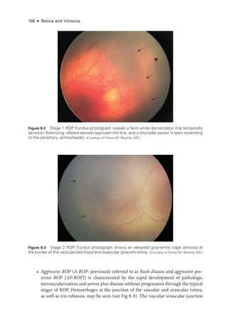 196 ● Retina and Vitreous
Figure 8-2 Stage 1 ROP
. Fundus photo­
graph reveals a faint white demarcation line temporally
(arrows). Arborizing, dilated vessels approach the line, and a choroidal vessel is seen extending
to the periphery (arrowheads). (Courtesy of Franco M. Recchia, MD.)
Figure 8-3 Stage 2 ROP
. Fundus photo­
graph shows an elevated gray-­
white ridge (arrows) at
the border of the vascularized (rosy) and avascular (grayish) ret­ina. (Courtesy of Franco M. Recchia, MD.)
• Aggressive ROP (A-­ROP; previously referred to as Rush disease and aggressive pos-
terior ROP [AP-­
ROP]) is characterized by the rapid development of pathologic
neovascularization and severe plus disease without progression through the typical
stages of ROP. Hemorrhages at the junction of the vascular and avascular ret­
ina,
as well as iris rubeosis, may be seen (see Fig 8-8). The vascular‒avascular junction
 