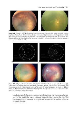 CHAPTER 8: Retinopathy of Prematurity ● 197
A B
A
C
Retinal
detachment
(extrafoveal)
12
9
3
6
I
II
III
B
D
Retinal
detachment
(including fovea)
12
9 3
6
I
II
III
Figure 8-4 Stage 3 ROP
. A, Fundus photo­
graph shows fibrovascular tissue (arrows) extend-
ing from the surface of the ret­
ina into the vitreous and preret­
i­
nal hemorrhage (lower right).
B, Fundus photo­
graph shows an elevated circumferential fibrovascular ridge and marked plus
disease (dilation and tortuosity of all posterior vessels). (Part A courtesy of Colin A. McCannel, MD; part B
courtesy of Franco M. Recchia, MD.)
Figure 8-5 Stage 4 ROP
. Schematic repre­
sen­
ta­
tions show stage 4A (A) and stage 4B (B).
The roman numerals in each circle indicate the zones, per the international classification, and
the arabic numerals indicate clock-­
hours. Wide-­
angle clinical photo­
graphs of stage 4A (C) and
stage 4B (D) correspond to the schematic diagrams. (Parts A and B courtesy of J. Arch McNamara, MD;
parts C and D courtesy of Audina Berrocal, MD.)
may be deceptively featureless, with neovascularization appearing only as a flat net-
work of fine vessels that may be confused with under­
lying choroid (Fig 8-9). This
phenomenon is not restricted to the posterior ret­
ina or to the smallest infants, as
originally thought.
 