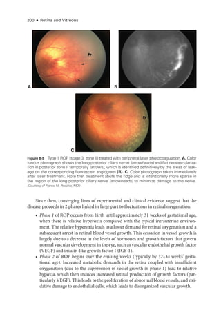 200 ● Retina and Vitreous
Since then, converging lines of experimental and clinical evidence suggest that the
disease proceeds in 2 phases linked in large part to fluctuations in ret­
i­
nal oxygenation:
• Phase 1 of ROP occurs from birth ­
until approximately 31 weeks of gestational age,
when ­
there is relative hyperoxia compared with the typical intrauterine environ-
ment. The relative hyperoxia leads to a lower demand for ret­
i­
nal oxygenation and a
subsequent arrest in ret­
i­
nal blood vessel growth. This cessation in vessel growth is
largely due to a decrease in the levels of hormones and growth ­
factors that govern
normal vascular development in the eye, such as vascular endothelial growth ­
factor
(VEGF) and insulin-­
like growth ­
factor 1 (IGF-1).
• Phase 2 of ROP begins over the ensuing weeks (typically by 32–34 weeks’ gesta-
tional age). Increased metabolic demands in the ret­
ina coupled with insufficient
oxygenation (due to the suppression of vessel growth in phase 1) lead to relative
hypoxia, which then induces increased ret­
i­
nal production of growth ­
factors (par-
ticularly VEGF). This leads to the proliferation of abnormal blood vessels, and oxi-
dative damage to endothelial cells, which leads to disor­
ga­
nized vascular growth.
Figure 8-9 Type 1 ROP (stage 3, zone II) treated with peripheral ­
laser photocoagulation. A, Color
fundus photo­
graph shows the long posterior ciliary nerve (arrowheads) and flat neovasculariza-
tion in posterior zone II temporally (arrows), which is identified definitively by the areas of leak-
age on the corresponding fluorescein angiogram (B). C, Color photo­
graph taken immediately
­
after ­
laser treatment. Note that treatment abuts the ridge and is intentionally more sparse in
the region of the long posterior ciliary nerve (arrowheads) to minimize damage to the nerve.
(Courtesy of Franco M. Recchia, MD.)
A B
C
 