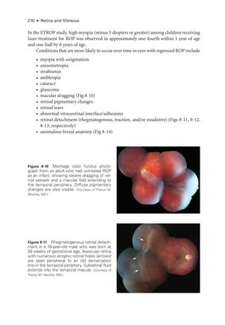 210 ● Retina and Vitreous
In the ETROP study, high myopia (minus 5 diopters or greater) among ­
children receiving
­
laser treatment for ROP was observed in approximately one-­
fourth within 1 year of age
and one-­
half by 6 years of age.
Conditions that are more likely to occur over time in eyes with regressed ROP include
• myopia with astigmatism
• anisometropia
• strabismus
• amblyopia
• cataract
• glaucoma
• macular dragging (Fig 8-10)
• ret­i­nal pigmentary changes
• ret­i­nal tears
• abnormal vitreoret­i­nal interface/adhesions
• ret­
i­
nal detachment (rhegmatogenous, traction, and/or exudative) (Figs 8-11, 8-12,
8-13, respectively)
• anomalous foveal anatomy (Fig 8-14)
Figure 8-11 Rhegmatogenous ret­i­nal detach-
ment in a 16-­
year-­
old male who was born at
26 weeks of gestational age. Avascular ret­
ina
with numerous atrophic ret­
i­
nal holes (arrows)
are seen peripheral to an old demarcation
line in the temporal periphery. Subret­
i­
nal fluid
extends into the temporal macula. (Courtesy of
Franco M. Recchia, MD.)
Figure 8-10 Montage color fundus photo­
graph from an adult who had untreated ROP
as an infant, showing severe dragging of ret­
i­
nal vessels and a macular fold extending to
the temporal periphery. Diffuse pigmentary
changes are also visible. (Courtesy of Franco M.
Recchia, MD.)
 