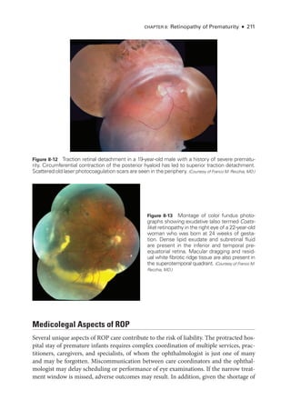 CHAPTER 8: Retinopathy of Prematurity ● 211
Figure 8-12 Traction ret­
i­
nal detachment in a 19-­
year-­
old male with a history of severe prematu-
rity. Circumferential contraction of the posterior hyaloid has led to superior traction detachment.
Scattered old ­
laser photocoagulation scars are seen in the periphery. (Courtesy of Franco M. Recchia, MD.)
Figure 8-13 Montage of color fundus photo­
graphs showing exudative (also termed Coats-­
like) retinopathy in the right eye of a 22-­
year-­
old
­
woman who was born at 24 weeks of gesta-
tion. Dense lipid exudate and subret­
i­
nal fluid
are pre­
sent in the inferior and temporal pre-­
equatorial ret­
ina. Macular dragging and resid-
ual white fibrotic ridge tissue are also pre­
sent in
the superotemporal quadrant. (Courtesy of Franco M.
Recchia, MD.)
Medicolegal Aspects of ROP
Several unique aspects of ROP care contribute to the risk of liability. The protracted hos-
pital stay of premature infants requires complex coordination of multiple ser­
vices, prac­
ti­
tion­
ers, caregivers, and specialists, of whom the ophthalmologist is just one of many
and may be forgotten. Miscommunication between care coordinators and the ophthal-
mologist may delay scheduling or per­
for­
mance of eye examinations. If the narrow treat-
ment win­
dow is missed, adverse outcomes may result. In addition, given the shortage of
 