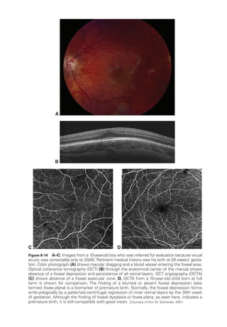 C
A
D
B
Figure 8-14 A–­C: Images from a 10-year-old boy who was referred for evaluation ­
because visual
acuity was correctable only to 20/40. Pertinent medical history was his birth at 28 weeks’ gesta-
tion. Color photo­graph (A) shows macular dragging and a blood vessel entering the foveal area.
Optical coherence tomography (OCT) (B) through the anatomical center of the macula shows
absence of a foveal depression and per­
sis­
tence of all ret­
i­
nal layers. OCT angiography (OCTA)
(C) shows absence of a foveal avascular zone. D, OCTA from a 10-­
year-­
old child born at full
term is shown for comparison. The finding of a blunted or absent foveal depression (also
termed fovea plana) is a biomarker of premature birth. Normally, the foveal depression forms
embryologically by a patterned centrifugal regression of inner ret­
i­
nal layers by the 30th week
of gestation. Although the finding of foveal dysplasia or fovea plana, as seen ­
here, indicates a
premature birth, it is still compatible with good vision. (Courtesy of Eric W. Schneider, MD.)
 