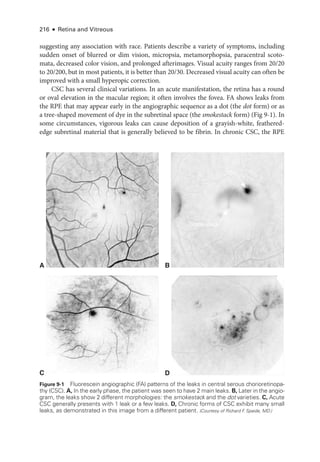 216 ● Retina and Vitreous
suggesting any association with race. Patients describe a variety of symptoms, including
sudden onset of blurred or dim vision, micropsia, metamorphopsia, paracentral scoto­
mata, decreased color vision, and prolonged afterimages. Visual acuity ranges from 20/20
to 20/200, but in most patients, it is better than 20/30. Decreased visual acuity can often be
improved with a small hyperopic correction.
CSC has several clinical variations. In an acute manifestation, the ret­
ina has a round
or oval elevation in the macular region; it often involves the fovea. FA shows leaks from
the RPE that may appear early in the angiographic sequence as a dot (the dot form) or as
a tree-­
shaped movement of dye in the subret­
i­
nal space (the smokestack form) (Fig 9-1). In
some circumstances, vigorous leaks can cause deposition of a grayish-­
white, feathered-­
edge subret­
i­
nal material that is generally believed to be fibrin. In chronic CSC, the RPE
A B
D
C
Dot
Smokestack
Figure 9-1 Fluorescein angiographic (FA) patterns of the leaks in central serous chorioretinopa-
thy (CSC). A, In the early phase, the patient was seen to have 2 main leaks. B, ­
Later in the angio-
gram, the leaks show 2 dif­
fer­
ent morphologies: the smokestack and the dot va­ri­e­ties. C, Acute
CSC generally pre­
sents with 1 leak or a few leaks. D, Chronic forms of CSC exhibit many small
leaks, as demonstrated in this image from a dif­
fer­
ent patient. (Courtesy of Richard F
. Spaide, MD.)
 