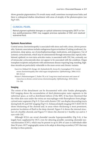 CHAPTER 9: Choroidal Disease ● 217
shows granular pigmentation; FA reveals many small, sometimes inconspicuous leaks; and
­
there is widespread shallow detachment with areas of atrophy of the photoreceptors (see
Fig 9-1D).
CLINICAL PEARL
Ret­
i­
nal pigment epithelial changes on optical coherence tomography (OCT) or fun­
dus autofluorescence (FAF) may suggest previous episodes of CSC and resolved
subret­i­nal fluid.
Systemic Associations
Central serous chorioretinopathy is associated with stress and with a tense, driven person­
ality. Systemic associations include endogenous hypercortisolism (Cushing syndrome), hy­
pertension, sleep apnea, use of psychopharmacologic medi­
cations, and pregnancy. Use of
systemic corticosteroids, which may be administered through intramuscular, topical, inha­
lational, epidural, or even intra-­
articular routes, is associated with CSC; but, curiously, use
of intraocular corticosteroids does not appear to be associated with the condition. Organ
transplant recipients and patients with autoimmune disease requiring long-­
standing, high-­
dose ste­
roids are particularly vulnerable to the more severe and chronic variants.
Fawzi AA, Holland GN, Kreiger AE, Heckenlively JR, Arroyo JG, Cunningham ET Jr. Central
serous chorioretinopathy ­
after solid organ transplantation. Ophthalmology. 2006;113(5):
805–813.e5.
Mrejen S, Balaratnasingam C, Kaden TR, et al. Long-­
term visual outcomes and ­
causes of
vision loss in chronic central serous chorioretinopathy. Ophthalmology. 2019;126(4):
576–588.
Imaging
The extent of the detachment can be documented with color fundus photo­
graphs.
FAF imaging shows the accumulation of shed photoreceptor outer segments in the
subret­
i­
nal space, as well as distributed defects of the RPE. It has been theorized that
the white dots seen ­
under the ret­
ina are macrophages with fluorophores from phago­
cytized outer segments (Fig 9-2). Eyes with chronic CSC can display descending tracts
during both FA and FAF imaging (Fig 9-3). Enhanced depth imaging OCT (EDI-­OCT)
shows thickening of the choroid and, in areas where thickening is most prominent,
posterior loculation of fluid in the deep choroid. Figure 9-4 shows the internal struc­
ture of a healthy choroid, and Figure 9-5 shows the choroid in 1 healthy eye and in 3
eyes with CSC.
Although ICGA can reveal choroidal vascular hyperpermeability (Fig 9-6), it has
largely been supplanted by OCT, even for detecting pos­
si­
ble coexisting choroidal neo­
vascularization (CNV), which may be pre­
sent in up to 20% of cases in individuals older
than 50 years. OCT angiography seems to be ­
adept at detecting secondary CNV that may
develop in ­
these patients.
 