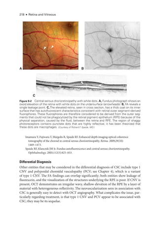 218 ● Retina and Vitreous
Imamura Y, Fujiwara T, Margolis R, Spaide RF. Enhanced depth imaging optical coherence
tomography of the choroid in central serous chorioretinopathy. Ret­i­na. 2009;29(10):
1469–1473.
Spaide RF, Klancnik JM Jr. Fundus autofluorescence and central serous chorioretinopathy.
Ophthalmology. 2005;112(5):825–833.
Differential Diagnosis
Other entities that may be considered in the differential diagnosis of CSC include type 1
CNV and polypoidal choroidal vasculopathy (PCV; see Chapter 4), which is a variant
of type 1 CNV. The FA findings can overlap significantly; both entities show leakage of
fluorescein, and the visualization of the structures under­
lying the RPE is poor. If CNV is
pre­
sent, OCT demonstrates an irregular wavy, shallow elevation of the RPE by a layer of
material with heterogeneous reflectivity. The neovascularization seen in association with
CSC is generally easy to detect with OCT angiography. What complicates the issue, par­
ticularly regarding treatment, is that type 1 CNV and PCV appear to be associated with
CSC; they may be its sequelae.
C
Punctate reflectors Shaggy
photoreceptors
A B
Figure 9-2 Central serous chorioretinopathy with white dots. A, Fundus photo­
graph shows an
ovoid elevation of the ret­
ina with white dots on the undersurface (arrowheads). B, FA reveals a
single leakage point. C, The elevated ret­
ina, seen in cross section, has a thick coat on its inner
surface that has autofluorescent characteristics consistent with ret­
i­
nal outer segment–­
derived
fluorophores. ­
These fluorophores are therefore considered to be derived from the outer seg-
ments that could not be phagocytized by the ret­
i­
nal pigment epithelium (RPE) ­
because of the
physical separation, caused by the fluid, between the ret­
ina and RPE. The region of shaggy
photoreceptors contains punctate dots that are highly reflective; it has been theorized that
­
these dots are macrophages. (Courtesy of Richard F
. Spaide, MD.)
 