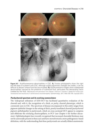 CHAPTER 9: Choroidal Disease ● 219
Pachychoroid spectrum and its evolving nomenclature
The widespread utilization of EDI-­
OCT has facilitated quantitative evaluation of the
choroid and, with it, the recognition of a thick, or pachy, choroid phenotype, which is
commonly seen in CSC. The spectrum of disease encompassed in this entity ranges from
pigment epithelial changes in the setting of thick, poorly tessellated choroid (pachychoroid
pigment epitheliopathy) to pachyvessels, which on cross-­
sectional OCT appear to compress
and obliterate the overlying choriocapillaris, to PCV (see Chapter 4 for further discus­
sion). Ophthalmologists have recently recognized that increased choroidal thickness may
not be universally pre­sent in ­these eyes and have moved ­toward a more pathogene­sis-­based
definition, with the understanding that ­
these pachyvessels are actually dilated anastomotic
A
B
Figure 9-3 Autofluorescence abnormalities in CSC. A, Fundus photo­
graphs show the right
and left eyes of a patient with CSC. Although subtle pigmentary changes are vis­
i­
ble, it can be
difficult to discern where fluid has accumulated. B, Autofluorescent images show widespread
abnormalities induced by the presence of subret­
i­
nal fluid, particularly the descending tracts
created by the fluid. (Reproduced with permission from Elsevier. Imamura Y, Fujiwara T, Spaide RF
. Fundus auto-
fluorescence and visual acuity in central serous chorioretinopathy. Ophthalmology. 2011;118(4):700–705. Copyright 2011.)
 