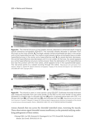 220 ● Retina and Vitreous
venous channels that run across the choroidal watershed zones, traversing the macula.
­
These observations signal choroidal venous insufficiency as the potential unifying under­
lying pathogenesis of ­
these entities.
Cheung CMG, Lee WK, Koizumi H, Dansingani K, Lai TYY, Freund KB. Pachychoroid
disease. Eye (Lond). 2019;33(1):14–33.
A
B
Figure 9-4 The internal structure of the healthy choroid, depicted on enhanced depth imaging
optical coherence tomography (EDI-­
OCT). The choroidal vessels decrease in dia­
meter from
the outer to the inner choroid. A, The larger vessels (white arrowheads) are dark in the center
with a thick hyperreflective wall.The medium-­
sized vessels (yellow arrowheads) have a smaller
hyporeflective area in the center and a hyperreflective wall. B, As vessel dia­
meter decreases,
the central hyporeflective area decreases ­
until it is not vis­
i­
ble. At that size, the vessel appears
as a white hyperreflective structure (white arrows). Note the delineation of the hyporeflective
line near the junction with the inner sclera, which appears to be in the suprachoroidal space.
The red arrow points to a vessel coursing through the sclera. (Reproduced with permission from
Elsevier. Mrejen S, Spaide RF
. Optical coherence tomography: imaging of the choroid and beyond. Surv Ophthalmol.
2013;58(5):387–429. Copyright 2013.)
A B
D
C
217 μm 449 μm
546 μm 722 μm
Figure 9-5 The choroid is seen in cross section using EDI-­
OCT. Subfoveal choroidal thickness
was mea­
sured vertically from the outer border of the RPE to the inner border of the sclera
(brackets) in a healthy eye in a 55-­
year-­
old man (A) and in 3 representative eyes with CSC: in a
44-­year-­old man (B), a 57-­
year-­
old man (C), and a 63-­
year-­
old man (D). (Reproduced with permission
from Imamura Y, Fujiwara T, Margolis R, Spaide RF
. Enhanced depth imaging optical coherence tomography of the choroid
in central serous chorioretinopathy. Ret­i­na. 2009;29(10):1469–1473. doi:10.1097/IAE.0b013e3181be0a83)
 
