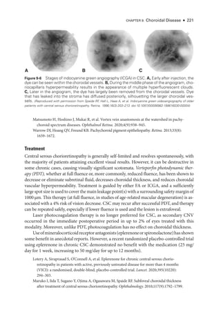 CHAPTER 9: Choroidal Disease ● 221
Matsumoto H, Hoshino J, Mukai R, et al. Vortex vein anastomosis at the watershed in pachy­
choroid spectrum diseases. Ophthalmol Ret­i­na. 2020;4(9):938–945.
Warrow DJ, Hoang QV, Freund KB. Pachychoroid pigment epitheliopathy. Ret­i­na. 2013;33(8):
1659–1672.
Treatment
Central serous chorioretinopathy is generally self-­
limited and resolves spontaneously, with
the majority of patients attaining excellent visual results. However, it can be destructive in
some chronic cases, causing visually significant scotomata. Verteporfin photodynamic ther-
apy (PDT), ­
whether at full fluence or, more commonly, reduced fluence, has been shown to
decrease or eliminate subret­
i­
nal fluid, decreases choroidal thickness, and reduces choroidal
vascular hyperpermeability. Treatment is guided by ­
either FA or ICGA, and a sufficiently
large spot size is used to cover the main leakage point(s) with a surrounding safety margin of
1000 µm. This therapy (at full fluence, in studies of age-­
related macular degeneration) is as­
sociated with a 4% risk of vision decrease. CSC may recur ­
after successful PDT, and therapy
can be repeated safely, especially if lower fluence is used and the lesion is extrafoveal.
­
Laser photocoagulation therapy is no longer preferred for CSC, as secondary CNV
occurred in the immediate postoperative period in up to 2% of eyes treated with this
modality. Moreover, unlike PDT, photocoagulation has no effect on choroidal thickness.
Useofmineralocorticoidreceptorantagonists(eplerenoneorspironolactone)hasshown
some benefit in anecdotal reports. However, a recent randomized placebo-­
controlled trial
using eplerenone in chronic CSC demonstrated no benefit with the medi­
cation (25 mg/
day for 1 week, increasing to 50 mg/day for up to 12 months).
Lotery A, Sivaprasad S, O’Connell A, et al. Eplerenone for chronic central serous chorio­
retinopathy in patients with active, previously untreated disease for more than 4 months
(VICI): a randomised, double-­
blind, placebo-­
controlled trial. Lancet. 2020;395(10220):
294–303.
Maruko I, Iida T, Sugano Y, Ojima A, Ogasawara M, Spaide RF. Subfoveal choroidal thickness
­
after treatment of central serous chorioretinopathy. Ophthalmology. 2010;117(9):1792–1799.
C
A B
Figure 9-6 Stages of indocyanine green angiography (ICGA) in CSC. A, Early ­
after injection, the
dye can be seen within the choroidal vessels. B, During the ­middle phase of the angiogram, cho-
riocapillaris hyperpermeability results in the appearance of multiple hyperfluorescent clouds.
C, ­
Later in the angiogram, the dye has largely been removed from the choroidal vessels. Dye
that has leaked into the stroma has diffused posteriorly, silhouetting the larger choroidal ves-
sels. (Reproduced with permission from Spaide RF
, Hall L, Haas A, et al. Indocyanine green videoangiography of older
patients with central serous chorioretinopathy. Ret­i­na. 1996;16(3):203–213. doi:10.1097/00006982-199616030-00004)
 
