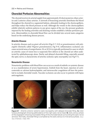 222 ● Retina and Vitreous
Choroidal Perfusion Abnormalities
The choroid receives its arterial supply from approximately 20 short posterior ciliary arter­
ies and 2 anterior ciliary arteries. A network of branching arterioles distributes the blood
throughout the choroid in a segmental fashion, ultimately leading to the choriocapillaris,
and helps reduce the blood pressure as well. Although the vessels in the choriocapillaris
exhibit relatively uniform patterns in any given region of the eye, the pressure gradients
imposed by the feeding arterioles and draining venules establish a lobular perfusion pat­
tern. Abnormalities in choroidal blood flow can be divided into several main categories
based on the under­
lying disease pro­
cess.
Arteritic Disease
In arteritic diseases such as ­
giant cell arteritis (Figs 9-7, 9-8) or granulomatosis with poly-
angiitis (formerly called Wegener granulomatosis; Fig 9-9), inflammatory occlusion can
cause sectorial areas of nonperfusion. FA or ICGA is typically performed in cases in which
an arteritic cause of vision loss is suspected; flow defects in the choroid are often unde­
tected by ophthalmoscopy alone. Patchy and delayed choroidal filling, especially around
the optic nerve, is characteristic of arteritic ischemic optic neuropathy (see Fig 9-7).
Nonarteritic Disease
Nonarteritic prob­lems with blood flow can occur as a result of embolic or systemic disease
or as a manifestation of severe hypertension. Emboli from the heart, injection of corti­
costeroids or calcium hydroxylapatite, and intravascular coagulation all have the poten­
tial to occlude choroidal vessels. Vascular occlusion can also occur in patients with lupus
anticoagulants.
A B
Figure 9-7 Arteritic anterior ischemic optic neuropathy with delayed choroidal filling. A, Color
fundus photo­
graph showing pallid edema of the right optic nerve head. B, Early venous phase
of the angiogram showing incomplete filling of the choroidal lobule surrounding the optic nerve
(arrows). Normally, choroidal filling is complete by the early venous to mid-­
venous phase. (Cour-
tesy of Nicholas J. Volpe, MD.)
 