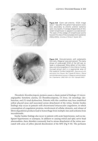 CHAPTER 9: Choroidal Disease ● 223
Thrombotic thrombocytopenic purpura ­
causes a classic pentad of findings: (1) micro­
angiopathic hemolytic anemia, (2) thrombocytopenia, (3) fever, (4) neurologic dys­
function, and (5) renal dysfunction. Patients with this condition may have multifocal
yellow placoid areas and associated serous detachment of the ret­
ina. Similar fundus
findings may occur in patients with disseminated intravascular coagulation, in which
consumption of coagulation proteins, involvement of cellular ele­
ments, and release of
fibrin degradation products lead to hemorrhage from multiple sites and ischemia from
microthrombi.
Similar fundus findings also occur in patients with acute hypertension, such as ma­
lignant hypertension or eclampsia. In addition to causing ret­
i­
nal and optic nerve head
abnormalities, ­
these disorders commonly lead to serous detachment of the ret­
ina asso­
ciated with areas of yellow placoid discoloration of the RPE (Fig 9-10). The perfusion
Figure 9-8 ­
Giant cell arteritis. ICGA image
taken 1 day ­
after this patient had severe vision
loss secondary to arteritic anterior ischemic
optic neuropathy. A wedge-­
shaped area of cho-
roidal nonperfusion is apparent (curved arrow).
The apex of the wedge of nonperfusion points
­
toward the area of the occluded short posterior
ciliary artery. (Courtesy of Richard F
. Spaide, MD.)
*
Figure 9-9 Granulomatosis with polyangiitis
(formerly, Wegener granulomatosis). The early
phase of wide-­
angle ICGA of the left eye re-
veals a widespread filling defect of the arteri-
oles and choriocapillaris in the inferior fundus
(curved arrow) and in a segmental area of
the superior fundus (asterisk). (Reproduced with
permission from Elsevier. Iida T, Spaide RF
, Kantor J. Ret­
i­
nal
and choroidal ­
arterial occlusion inWegener’s granulomatosis.
Am J Ophthalmol. 2002;133(1):151–152. Copyright 2002.)
 