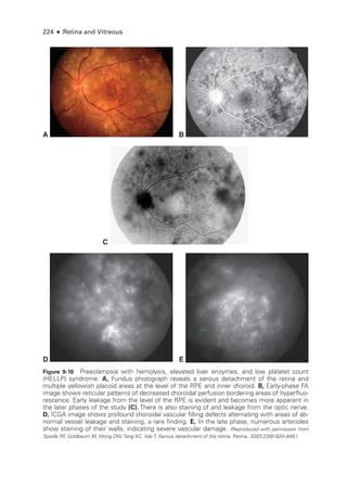 224 ● Retina and Vitreous
A B
D E
C
Figure 9-10 Preeclampsia with hemolysis, elevated liver enzymes, and low platelet count
(HELLP) syndrome. A, Fundus photo­
graph reveals a serous detachment of the ret­
ina and
multiple yellowish placoid areas at the level of the RPE and inner choroid. B, Early-­
phase FA
image shows reticular patterns of decreased choroidal perfusion bordering areas of hyperfluo-
rescence. Early leakage from the level of the RPE is evident and becomes more apparent in
the ­
later phases of the study (C). ­
There is also staining of and leakage from the optic nerve.
D, ICGA image shows profound choroidal vascular filling defects alternating with areas of ab-
normal vessel leakage and staining, a rare finding. E, In the late phase, numerous arterioles
show staining of their walls, indicating severe vascular damage. (Reproduced with permission from
Spaide RF
, Goldbaum M, Wong DW, Tang KC, Iida T. Serous detachment of the ret­
i­
na. Ret­i­na. 2003;23(6):820–846.)
 
