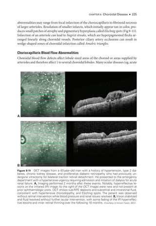 CHAPTER 9: Choroidal Disease ● 225
abnormalities may range from focal infarction of the choriocapillaris to fibrinoid necrosis
of larger arterioles. Resolution of smaller infarcts, which initially appear tan in color, pro­
duces small patches of atrophy and pigmentary hyperplasia called Elschnig spots (Fig 9-11).
Infarction of an arteriole can lead to Siegrist streaks, which are hyperpigmented flecks ar­
ranged linearly along choroidal vessels. Posterior ciliary artery occlusions can result in
wedge-­
shaped zones of choroidal infarction called Amalric triangles.
Choriocapillaris Blood Flow Abnormalities
Choroidal blood flow defects affect lobule-­
sized areas of the choroid or areas supplied by
arterioles and therefore affect 1 to several choroidal lobules. Many ocular diseases (eg, acute
A
B
Figure 9-11 OCT images from a 43-­
year-­
old man with a history of hypertension, type 2 dia-
betes, chronic kidney disease, and proliferative diabetic retinopathy who had previously un-
dergone vitrectomy for bilateral traction ret­
i­
nal detachment. He presented to the emergency
department with a hypertensive urgency requiring admission and initiation of dialysis for acute
renal failure. A, Imaging performed 2 months ­
after ­
these events. Notably, hyperreflective le-
sions on the infrared (IR) image (to the right of the OCT image) ­
were new and not pre­
sent at
prior ophthalmologic visits. OCT shows sub-­
RPE deposits and subret­
i­
nal and intraret­
i­
nal fluid,
consistent with hypertensive choroidopathy, and Elschnig spots. The patient was observed
without ret­
i­
nal intervention while blood pressure and renal issues resolved. B, Vision stabilized
and fluid resolved without further ocular intervention, with some fading of the IR hyperreflec-
tive lesions and inner ret­
i­
nal thinning over the following 18 months. (Courtesy of Amani Fawzi, MD.)
 