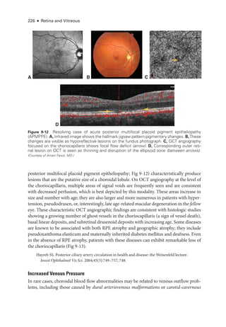 226 ● Retina and Vitreous
posterior multifocal placoid pigment epitheliopathy; Fig 9-12) characteristically produce
lesions that are the putative size of a choroidal lobule. On OCT angiography at the level of
the choriocapillaris, multiple areas of signal voids are frequently seen and are consistent
with decreased perfusion, which is best depicted by this modality. ­
These areas increase in
size and number with age; they are also larger and more numerous in patients with hyper­
tension, pseudodrusen, or, interestingly, late age-­
related macular degeneration in the fellow
eye. ­
These characteristic OCT angiographic findings are consistent with histologic studies
showing a growing number of ghost vessels in the choriocapillaris (a sign of vessel death),
basal linear deposits, and subret­
i­
nal drusenoid deposits with increasing age. Some diseases
are known to be associated with both RPE atrophy and geographic atrophy; they include
pseudoxanthoma elasticum and maternally inherited diabetes mellitus and deafness. Even
in the absence of RPE atrophy, patients with ­
these diseases can exhibit remarkable loss of
the choriocapillaris (Fig 9-13).
Hayreh SS. Posterior ciliary artery circulation in health and disease: the Weisenfeld lecture.
Invest Ophthalmol Vis Sci. 2004;45(3):749–757; 748.
Increased Venous Pressure
In rare cases, choroidal blood flow abnormalities may be related to venous outflow prob­
lems, including ­
those caused by dural arteriovenous malformations or carotid-­cavernous
C
A B
D
Figure 9-12 Resolving case of acute posterior multifocal placoid pigment epitheliopathy
(APMPPE). A, Infrared image shows the hallmark jigsaw pattern pigmentary changes. B,­These
changes are vis­
i­
ble as hyporeflective lesions on the fundus photo­
graph. C, OCT angiography
focused on the choriocapillaris shows focal flow deficit (arrow). D, Corresponding outer ret­
i­
nal lesion on OCT is seen as thinning and disruption of the ellipsoid zone (between arrows).
(Courtesy of Amani Fawzi, MD.)
 