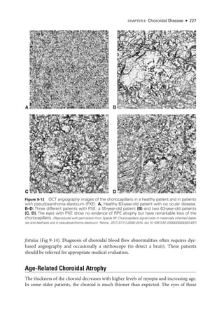 CHAPTER 9: Choroidal Disease ● 227
fistulas (Fig 9-14). Diagnosis of choroidal blood flow abnormalities often requires dye-­
based angiography and occasionally a stethoscope (to detect a bruit). ­
These patients
should be referred for appropriate medical evaluation.
Age-­
Related Choroidal Atrophy
The thickness of the choroid decreases with higher levels of myopia and increasing age.
In some older patients, the choroid is much thinner than expected. The eyes of ­
these
A B
D
C
Figure 9-13 OCT angiography images of the choriocapillaris in a healthy patient and in patients
with pseudoxanthoma elasticum (PXE). A, Healthy 63-­
year-­
old patient with no ocular disease.
B–­D: Three dif­
fer­
ent patients with PXE: a 55-­
year-old patient (B) and two 63-­
year-old patients
(C, D). The eyes with PXE show no evidence of RPE atrophy but have remarkable loss of the
choriocapillaris. (Reproduced with permission from Spaide RF
. Choriocapillaris signal voids in maternally inherited diabe-
tes and deafness and in pseudoxanthoma elasticum. Ret­i­na. 2017;37(11):2008–2014. doi:10.1097/IAE.0000000000001497)
 