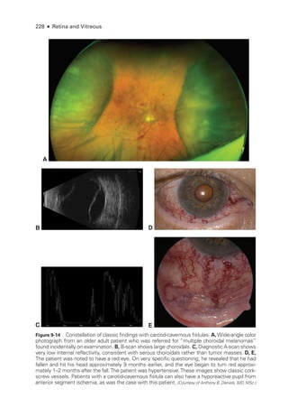 228 ● Retina and Vitreous
A
E
C
D
B
Figure 9-14 Constellation of classic findings with carotid-­
cavernous fistulas. A,Wide-­angle color
photo­
graph from an older adult patient who was referred for “multiple choroidal melanomas”
found incidentally on examination. B, B-­
scan shows large choroidals. C, Diagnostic A-­
scan shows
very low internal reflectivity, consistent with serous choroidals rather than tumor masses. D, E,
The patient was noted to have a red eye. On very specific questioning, he revealed that he had
fallen and hit his head approximately 9 months ­
earlier, and the eye began to turn red approxi-
mately 1–2 months ­
after the fall.The patient was hypertensive.­
These images show classic cork-
screw vessels. Patients with a carotid-­
cavernous fistula can also have a hyporeactive pupil from
anterior segment ischemia, as was the case with this patient. (Courtesy of Anthony B. Daniels, MD, MSc.)
 