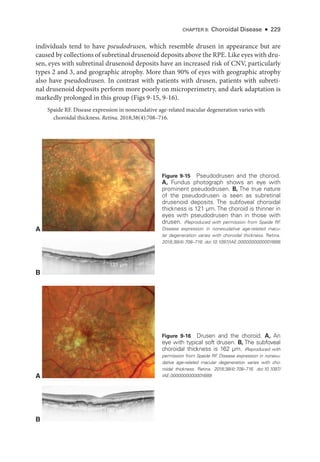 CHAPTER 9: Choroidal Disease ● 229
individuals tend to have pseudodrusen, which resemble drusen in appearance but are
caused by collections of subret­i­nal drusenoid deposits above the RPE. Like eyes with dru­
sen, eyes with subret­
i­
nal drusenoid deposits have an increased risk of CNV, particularly
types 2 and 3, and geographic atrophy. More than 90% of eyes with geographic atrophy
also have pseudodrusen. In contrast with patients with drusen, patients with subret­
i­
nal drusenoid deposits perform more poorly on microperimetry, and dark adaptation is
markedly prolonged in this group (Figs 9-15, 9-16).
Spaide RF. Disease expression in nonexudative age-­
related macular degeneration varies with
choroidal thickness. Ret­i­na. 2018;38(4):708–716.
A
B
121 μm
Figure 9-15 Pseudodrusen and the choroid.
A, Fundus photo­
graph shows an eye with
prominent pseudodrusen. B, The true nature
of the pseudodrusen is seen as subret­
i­
nal
drusenoid deposits. The subfoveal choroidal
thickness is 121 µm. The choroid is thinner in
eyes with pseudodrusen than in ­
those with
drusen. (Reproduced with permission from Spaide RF
.
Disease expression in nonexudative age-­
related macu-
lar degeneration varies with choroidal thickness. Ret­ina.
2018;38(4):708–716. doi:10.1097/IAE.0000000000001689)
A
B
162 μm
Figure 9-16 Drusen and the choroid. A, An
eye with typical soft drusen. B, The subfoveal
choroidal thickness is 162 µm. (Reproduced with
permission from Spaide RF
. Disease expression in nonexu-
dative age-­
related macular degeneration varies with cho-
roidal thickness. Ret­ina. 2018;38(4):708–716. doi:10.1097/
IAE.0000000000001689)
 