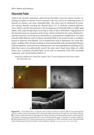 230 ● Retina and Vitreous
Choroidal Folds
Folds in the choroid, sometimes called chorioret­i­nal folds, occur for vari­
ous reasons, in­
cluding secondary to disease. Forces external to the eye, such as an indenting tumor or
thyroid eye disease, can cause choroidal folds. The sclera may be thickened by poste­
rior scleritis, thereby crowding the choroid (Fig 9-17). A relatively common phenom­
enon, which is poorly characterized, is the development of choroidal folds in middle-­
aged
adults, with acquired hyperopia occurring in some of ­
these individuals. Engorgement of
the choroid ­
causes an expansion of the tissue, which is ­
limited by the sclera. Reduced in­
traocular pressure, occurring most commonly as a postoperative complication, can cause
ciliochoroidal effusions and curvilinear choroidal folds in the posterior pole, a condition
known as hypotony maculopathy. Use of medi­
cations such as topiramate can cause idio­
pathic swelling of the choroid resulting in chorioret­
i­
nal folds and ciliochoroidal effusions
without hypotony. Increased intracranial pressure can cause papilledema resulting in fine
folds that course circumferentially around the optic nerve head; ­
these folds are called
Patton lines. Localized choroidal folds can be seen in association with CNV, choroidal
neoplasms, and scleral buckles (­
Table 9-1).
Spaide RF, Goldbaum M, Wong DW, Tang KC, Iida T. Serous detachment of the ret­
ina. Ret­i­na.
2003;23(6):820–846.
A B
C
Figure 9-17 Choroidal folds in a patient with nodular posterior scleritis. A, Fundus photo­
graph
shows subtle striae associated with choroidal folds extending through the temporal macula.
B, Fundus autofluorescence highlights the striae of folds with alternating hyper-­and hypoauto­
fluorescent changes emanating from the inferotemporal area of posterior nodular scleritis.
C, Spectral-­
domain OCT shows characteristic undulations of RPE consistent with choroidal folds
and a thickening choroid consistent with posterior scleritis. (Courtesy of Avni P
. Finn, MD, MBA.)
 
