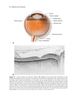 6 ● Retina and Vitreous
Wieger ligament
Vitreous base
Premacular bursa
Area of Martegiani
Fovea
Zonule
Anterior hyaloid
Cloquet canal
Berger space
A
B
Figure 1-1 Cross section of vitreous anatomy. A, Diagram of the eye with emphasis on the
anatomical features of the vitreous.The vitreous is most firmly attached to the ret­
ina at the vitre-
ous base, and it also has adhesions at the optic nerve, along vessels, at the fovea, and to the
posterior lens capsule. A prominent area of liquefaction of the premacular vitreous gel is called
the premacular bursa, or precortical vitreous pocket. B, Swept-­
source optical coherence tomog-
raphy image of the posterior vitreous and macular region demonstrates the signal void in the
vitreous cavity in front of the macula that represents the premacular bursa (arrowheads). Note
also the very thick macular choroid and photoreceptor disruption in the central macula, extend-
ing nasally. (Part A illustration by Mark M. Miller; part B courtesy of SriniVas Sadda, MD.)
 