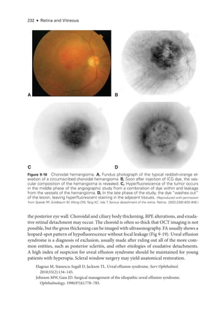 232 ● Retina and Vitreous
the posterior eye wall. Choroidal and ciliary body thickening, RPE alterations, and exuda­
tive ret­
i­
nal detachment may occur. The choroid is often so thick that OCT imaging is not
pos­si­ble, but the gross thickening can be imaged with ultrasonography. FA usually shows a
leopard-­
spot pattern of hypofluorescence without focal leakage (Fig 9-19). Uveal effusion
syndrome is a diagnosis of exclusion, usually made ­
after ruling out all of the more com­
mon entities, such as posterior scleritis, and other etiologies of exudative detachments.
A high index of suspicion for uveal effusion syndrome should be maintained for young
patients with hyperopia. Scleral win­
dow surgery may yield anatomical restoration.
Elagouz M, Stanescu-­
Segall D, Jackson TL. Uveal effusion syndrome. Surv Ophthalmol.
2010;55(2):134–145.
Johnson MW, Gass JD. Surgical management of the idiopathic uveal effusion syndrome.
Ophthalmology. 1990;97(6):778–785.
A B
C D
Figure 9-18 Choroidal hemangioma. A, Fundus photo­
graph of the typical reddish-­
orange el-
evation of a circumscribed choroidal hemangioma. B, Soon ­
after injection of ICG dye, the vas-
cular composition of the hemangioma is revealed. C, Hyperfluorescence of the tumor occurs
in the ­
middle phase of the angiographic study from a combination of dye within and leakage
from the vessels of the hemangioma. D, In the late phase of the study, the dye “washes out”
of the lesion, leaving hyperfluorescent staining in the adjacent tissues. (Reproduced with permission
from Spaide RF
, Goldbaum M, Wong DW,Tang KC, Iida T. Serous detachment of the ret­
i­
na. Ret­i­na. 2003;23(6):820–846.)
 
