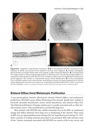 CHAPTER 9: Choroidal Disease ● 233
Bilateral Diffuse Uveal Melanocytic Proliferation
A rare paraneoplastic disorder affecting the choroid, bilateral diffuse uveal melanocytic
proliferation (BDUMP) ­
causes diffuse thickening of the choroid, “giraffe skin” reddish or
brownish choroidal discoloration, serous ret­
i­
nal detachment, and cataracts (Fig 9-20).
The bilateral proliferation of benign melanocytes is usually associated with or often her­
alds systemic cancer. ­
These proliferations can look like large nevi.
Most patients with BDUMP also exhibit nummular loss of the RPE, an anatomical
change that differs distinctly from large nevi or thickening of the choroid. ­
These areas
of RPE loss are hypoautofluorescent during FAF but hyperfluorescent during FA. OCT
shows mounds of residual material, presumed to be per­
sis­
tent RPE cells, between areas
of loss. Tumors commonly associated with BDUMP are cancers of the ovary, uterus, and
A B
C D
Figure 9-19 Idiopathic uveal effusion syndrome. A–­C: In this patient’s left eye, visual acuity was
reduced to 20/70, and results of the systemic workup ­
were negative. A, Fundus photo­
graph
demonstrates a blunted foveal reflex and irregular, subtle subret­
i­
nal deposits. B, Corresponding
FA image reveals a diffuse leopard-­
spot pattern of blocking with intervening win­
dow defects in-
volving the entire posterior pole. C, OCT scan reveals a small amount of subfoveal fluid and outer
ret­
i­
nal deposits. Not shown is a peripheral serous ret­
i­
nal detachment. D, Fundus photo­
graph
from a dif­
fer­
ent patient with recent-­
onset uveal effusion shows the typical appearance of serous
ret­
i­
nal detachment syndrome as well as an under­
lying choroidal detachment, which is common
for this condition. (Parts A–­
C courtesy of Ronald C. Gentile, MD; part D courtesy of Colin A. McCannel, MD.)
 