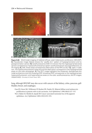 234 ● Retina and Vitreous
lung, although BDUMP may also occur with cancers of the kidney, colon, pancreas, gall­
bladder, breast, and esophagus.
Gass JD, Gieser RG, Wilkinson CP, Beahm DE, Pautler SE. Bilateral diffuse uveal melanocytic
proliferation in patients with occult carcinoma. Arch Ophthalmol. 1990;108(4):527–533.
Wu S, Slakter JS, Shields JA, Spaide RF. Cancer-­
associated nummular loss of the pigment
epithelium. Am J Ophthalmol. 2005;139(5):933–935.
A
C
B
Figure 9-20 Multimodal imaging of bilateral diffuse uveal melanocytic proliferation (BDUMP).
A, Pseudocolor image (Optos) shows the “giraffe skin” pattern of hypopigmentation and hy-
perpigmentation (arrow). B, Autofluorescence (530 nm) shows that the hyperpigmented areas
(arrow) correspond to hypoautofluorescence (green autofluorescence) and hyporeflectivity on
IR imaging (C, left).­
These areas correspond to attenuation of the RPE on OCT (C, right). In addi-
tion, the hyperautofluorescent areas around the attenuation correspond to the hypopigmented
areas on the color photo­
graph. C, The OCT image highlights the thickened, disor­
ga­
nized cho-
roidal architecture and the thickened RPE (thickened RPE corresponds to the hypopigmented,
hyperautofluorescent, and hyperreflective areas on the color, autofluorescence, and IR images,
respectively). (Courtesy of Amani Fawzi, MD.)
 