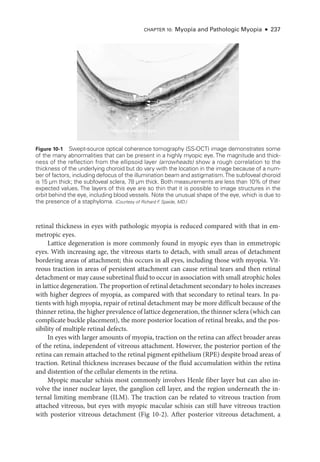 Chapter 10: Myopia and Pathologic Myopia ● 237
ret­
i­
nal thickness in eyes with pathologic myopia is reduced compared with that in em-
metropic eyes.
Lattice degeneration is more commonly found in myopic eyes than in emmetropic
eyes. With increasing age, the vitreous starts to detach, with small areas of detachment
bordering areas of attachment; this occurs in all eyes, including ­
those with myopia. Vit-
reous traction in areas of per­
sis­
tent attachment can cause ret­
i­
nal tears and then ret­
i­
nal
detachment or may cause subret­i­nal fluid to occur in association with small atrophic holes
in lattice degeneration. The proportion of ret­i­nal detachment secondary to holes increases
with higher degrees of myopia, as compared with that secondary to ret­
i­
nal tears. In pa-
tients with high myopia, repair of ret­
i­
nal detachment may be more difficult ­
because of the
thinner ret­ina, the higher prevalence of lattice degeneration, the thinner sclera (which can
complicate buckle placement), the more posterior location of ret­
i­
nal breaks, and the pos-
sibility of multiple ret­
i­
nal defects.
In eyes with larger amounts of myopia, traction on the ret­
ina can affect broader areas
of the ret­
ina, in­
de­
pen­
dent of vitreous attachment. However, the posterior portion of the
ret­
ina can remain attached to the ret­
i­
nal pigment epithelium (RPE) despite broad areas of
traction. Ret­
i­
nal thickness increases ­
because of the fluid accumulation within the ret­
ina
and distention of the cellular ele­
ments in the ret­
ina.
Myopic macular schisis most commonly involves Henle fiber layer but can also in-
volve the inner nuclear layer, the ganglion cell layer, and the region under­
neath the in-
ternal limiting membrane (ILM). The traction can be related to vitreous traction from
attached vitreous, but eyes with myopic macular schisis can still have vitreous traction
with posterior vitreous detachment (Fig 10-2). ­
After posterior vitreous detachment, a
Choroid 15 μm
Sclera 78 μm
Vessels behind eye
Figure 10-1 Swept-­
source optical coherence tomography (SS-­
OCT) image demonstrates some
of the many abnormalities that can be pre­
sent in a highly myopic eye. The magnitude and thick-
ness of the reflection from the ellipsoid layer (arrowheads) show a rough correlation to the
thickness of the under­
lying choroid but do vary with the location in the image ­
because of a num-
ber of ­
factors, including defocus of the illumination beam and astigmatism.The subfoveal choroid
is 15 µm thick; the subfoveal sclera, 78 µm thick. Both mea­
sure­
ments are less than 10% of their
expected values. The layers of this eye are so thin that it is pos­
si­
ble to image structures in the
orbit ­
behind the eye, including blood vessels. Note the unusual shape of the eye, which is due to
the presence of a staphyloma. (Courtesy of Richard F
. Spaide, MD.)
 