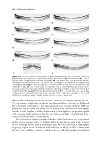 238 ● Retina and Vitreous
skim coat of vitreous remains on the surface of the ret­
ina and appears to cause traction.
Varying amounts of epiret­
i­
nal membrane may also contribute to the traction. Peeling of
the ILM results in resolution of the schisis, typically near the area where the ILM was
peeled; this has led to the conclusion that the ILM may be altered in eyes with myopic
macular schisis. Another possibility is that many of ­
these eyes have progressive myopia
with continued ocular expansion. The ILM may not necessarily be remodeled, and there-
fore it may not expand like the outer ret­
ina.
More advanced tractional changes can lead to ret­
i­
nal detachment over staphylomas
and to myopic macular holes. For macular holes, the rate of successful repair is lower
in eyes with high myopia than in emmetropic eyes. Also, macular holes in high myopia
frequently require use of the inverted ILM technique, in which the ILM is folded over
the hole prior to fluid gas exchange. In addition, in eyes with high myopia, macular holes
A B
C D
E F
G H
I J
Figure 10-2 Successive OCT examinations of a female patient with myopic macular schisis. At
pre­
sen­
ta­
tion, the patient had a perifoveal vitreous detachment (A) that separated (B). C, Four
months ­
later, a larger foveal cavitation developed. D, One month ­
after that, a localized detach-
ment of the fovea occurred. E–­F: One month ­
after the image in D was taken, the detachment
was slightly larger (E) and persisted (F). G, At 4-­
month follow-up, the macular detachment had
increased in size. H, One month ­
later, she returned with a substantial loss of central vision.
Imaging revealed a large ret­
i­
nal detachment with edematous folding of the outer ret­
ina. I, A
small macular hole caused the larger detachment (arrow). J,The macular hole was repaired by
vitrectomy with internal limiting membrane removal, which resulted in resolution of the ret­
i­
nal
detachment and the myopic macular schisis. (Courtesy of Richard F
. Spaide, MD.)
 