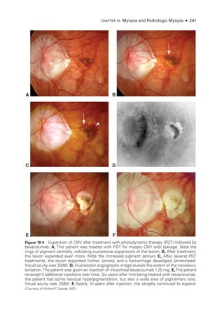 Chapter 10: Myopia and Pathologic Myopia ● 241
B
A
D
C
F
E
Figure 10-4 Expansion of CNV ­
after treatment with photodynamic therapy (PDT) followed by
bevacizumab. A, This patient was treated with PDT for myopic CNV with leakage. Note the
rings of pigment centrally, indicating successive expansions of the lesion. B, ­After treatment,
the lesion expanded even more. Note the increased pigment (arrow). C, ­
After several PDT
treatments, the lesion expanded further (arrow), and a hemorrhage developed (arrowhead).
Visual acuity was 20/80. D, Fluorescein angiography image reveals the extent of the neovascu-
larization.The patient was given an injection of intravitreal bevacizumab 1.25 mg. E,The patient
received 2 additional injections over time. Six years ­
after first being treated with bevacizumab,
the patient had some residual hyperpigmentation, but also a wide area of pigmentary loss.
Visual acuity was 20/60. F, Nearly 10 years ­
after injection, the atrophy continued to expand.
(Courtesy of Richard F
. Spaide, MD.)
 