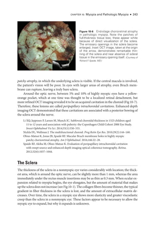 Chapter 10: Myopia and Pathologic Myopia ● 243
patchy atrophy, in which the under­
lying sclera is vis­
i­
ble. If the central macula is involved,
the patient’s vision ­
will be poor. In eyes with larger areas of atrophy, even Bruch mem-
brane can rupture, leaving a truly bare sclera.
Around the optic nerve, between 5% and 10% of highly myopic eyes have a yellow-­
orange pocket, which at one time was thought to be a localized ret­
i­
nal detachment, but
more refined OCT imaging revealed it to be an acquired cavitation in the choroid (Fig 10-7).
Therefore, ­
these lesions are called peripapillary intrachoroidal cavitations. Enhanced depth
imaging OCT demonstrated that ­
these cavitations are associated with a posterior bowing of
the sclera around the nerve.
Li XQ, Jeppesen P, Larsen M, Munch IC. Subfoveal choroidal thickness in 1323 ­
children aged
11 to 12 years and association with puberty: the Copenhagen Child Cohort 2000 Eye Study.
Invest Ophthalmol Vis Sci. 2014;55(1):550–555.
Nickla DL, Wallman J. The multifunctional choroid. Prog Retin Eye Res. 2010;29(2):144–168.
Ohno-­
Matsui K, Jonas JB, Spaide RF. Macular Bruch membrane holes in highly myopic
patchy chorioret­i­nal atrophy. Am J Ophthalmol. 2016;166:22–28.
Spaide RF, Akiba M, Ohno-­
Matsui K. Evaluation of peripapillary intrachoroidal cavitation
with swept source and enhanced depth imaging optical coherence tomography. Ret­i­na.
2012;32(6):1037–1044.
The Sclera
The thickness of the sclera in a nonmyopic eye varies considerably with location; the thick-
est area, which is around the optic nerve, can be slightly more than 1 mm, whereas the area
immediately ­
under the rectus muscle insertions may be as thin as 0.3 mm. When ocular ex-
pansion related to myopia begins, the eye elongates, but the amount of material that makes
up the sclera does not increase (see Fig 10-1). The collagen fibers become thinner, the typical
gradient in fiber thickness in the sclera is lost, and the amount of extracellular matrix de-
creases. Over time, the sclera in a myopic eye shows more elasticity and greater viscoelastic
creep than the sclera in a nonmyopic eye. ­
These ­
factors appear to be necessary to allow the
myopic eye to expand, but why it expands is unknown.
Figure 10-6 End-­
stage chorioretinal atrophy
in pathologic myopia. Note the patches of
full-­
thickness tissue loss; these appear white
­
because of direct visualization of the sclera.
The emissary openings in the sclera become
enlarged. Inset: OCT image, taken at the origin
of the arrow, demonstrates remarkable thin-
ning of the sclera and near absence of scleral
tissue in the emissary opening itself. (Courtesy of
Richard F
. Spaide, MD.)
 