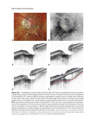 244 ● Retina and Vitreous
B
C
D
E
F
A
D
C
F
E
Figure 10-7 Peripapillary intrachoroidal cavitation. A, Color fundus photo­
graph shows the yellow-­
orange region of the intrachoroidal cavitation (white arrows).The green arrows show the locations
of subsequent OCT sections. B, Fluorescein angiography image shows a modest late collection
of dye within the cavity (white arrows). Note the upper edge of the cavity is sharply demarcated
(yellow arrow).The edge of the ret­
i­
nal defect is more clearly evident than in the color photo­
graph.
C–­F: Successive serial sections taken using SS-­
OCT show the inner ret­
i­
nal defect and the exten-
sion of the cavitation into the choroid. A veil of tissue extends through the thickness of the cho-
roid at the border of the cavitation. In F, the hyperreflective band that corresponds to the ret­
i­
nal
pigment epithelium is nearly straight, as illustrated by the blue dashed line.The red line follows a
posterior bowing at the center-­
point thickness in the sclera. (Used with permission from Spaide RF
, Akiba M,
Ohno-­
Matsui K. Evaluation of peripapillary intrachoroidal cavitation with swept source and enhanced depth imaging optical
coherence tomography. Ret­i­na. 2012;32(6):1037–1044. doi:10.1097/IAE.0b013e318242b9c0)
 