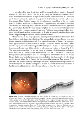 Chapter 10: Myopia and Pathologic Myopia ● 245
In animal models, form deprivation and lens-­
induced defocus result in abnormal
changes in axial length. Neither optic nerve sectioning nor the destruction of the ciliary
nerve prevents the development of experimental myopia. Form deprivation of a hemifield
results in expansion of the eye that is conjugate with that hemifield, even if the optic nerve
is sectioned. ­
These findings support the hypothesis that remodeling of the eye results
from local effects within the eye, beginning with signaling that originates in the ret­
ina
and choroid and eventually affects the sclera. Connection to the brain does not appear to
be necessary. Eyes that develop axial myopia lengthen, but in comparison to the posterior
pole, the periphery becomes relatively hyperopic. Peripheral hyperopia can induce myo-
pia in animal models, and curiously myopia can develop in eyes with peripheral hyperopia
even if the posterior portion of the ret­
ina has been destroyed.
Ocular expansion can vary regionally, inducing formation of areas of the sclera that
have differing radii of curvature. Bulging of the sclera and adherent uveal tissue in an area
of thin sclera, or staphyloma, can result from regional expansion of the eye. ­
These protru-
sions typically involve 3 general areas of the eye: (1) the area around the nerve; (2) the
macular region, which leads to exaggerated thinning of the choroid and possibly myopic
traction maculopathy; and (3) the inferior or inferotemporal portion of the eye (Fig 10-8).
The superior portion of the eye has one radius of curvature, the inferior portion has an-
other, and ­
there is a vis­
i­
ble border between ­
these 2 curves. If the border occurs above
the optic nerve, the optic nerve head ­
will appear grossly tilted and rotated. If the border
bisects the fovea, several alterations may be seen. In ­
later life, ­
there may be atrophy along
the border that affects the RPE ­
under the fovea, and ­
either subret­
i­
nal fluid without CNV
or frank CNV may also develop in ­these eyes. ­
Because a staphyloma involving the inferior
or inferotemporal eye may be accompanied by a set of pos­
si­
ble ocular manifestations, it
has been referred to as inferior staphyloma syndrome or tilted disc syndrome.
B
A Inferior
Superior
*
Figure 10-8 Inferior staphyloma syndrome, also known as tilted disc syndrome. A, Fundus
photo­
graph shows that the superior fundus is darker than the staphylomatous inferior fundus.
At the border between the 2 regions (arrowheads) ­
there is a pigmentary change in the macula
(yellow arrow). ­
Because this border runs through the superior border of the optic nerve head,
the patient has a tilted disc (white arrow). B, Dome-­
shaped macula. Vertical OCT image taken
through the fovea shows the 2 curves. At the ridge between them, ­
there is CNV (arrow) as-
sociated with a small amount of submacular fluid.The sclera is typically thicker at the border zone
(asterisk) than anywhere in the neighboring areas. (Courtesy of Richard F
. Spaide, MD.)
 