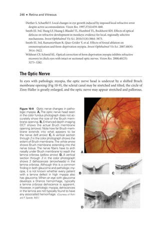246 ● Retina and Vitreous
Diether S, Schaeffel F. Local changes in eye growth induced by imposed local refractive error
despite active accommodation. Vision Res. 1997;37(6):659–668.
Smith EL 3rd, Hung LF, Huang J, Blasdel TL, Humbird TL, Bockhorst KH. Effects of optical
defocus on refractive development in monkeys: evidence for local, regionally selective
mechanisms. Invest Ophthalmol Vis Sci. 2010;51(8):3864–3873.
Smith EL 3rd, Ramamirtham R, Qiao-­
Grider Y, et al. Effects of foveal ablation on
emmetropization and form-­
deprivation myopia. Invest Ophthalmol Vis Sci. 2007;48(9):​
3914–3922.
Wildsoet CF, Schmid KL. Optical correction of form deprivation myopia inhibits refractive
recovery in chick eyes with intact or sectioned optic nerves. Vision Res. 2000;40(23):​
3273–3282.
The Optic Nerve
In eyes with pathologic myopia, the optic nerve head is undercut by a shifted Bruch
membrane opening (Fig 10-9), the scleral canal may be stretched and tilted, the circle of
Zinn-­
Haller is greatly enlarged, and the optic nerve may appear stretched and pallorous.
A
2 3
1
D
B C
Figure 10-9 Optic nerve changes in patho-
logic myopia. A, The optic nerve head seen
in the color fundus photo­
graph does not ac-
curately show the size of the Bruch mem-
brane opening. B, Enhanced depth imaging
OCT shows the ­
actual Bruch membrane
opening (arrows). Note how far Bruch mem-
brane extends into what appears to be
the nerve (left arrow). C, A vertical section
through 2 in the color photo­
graph shows the
extent of Bruch membrane.The white arrow
shows Bruch membrane extending into the
nerve tissue. The nerve fibers have to arch
nasally ­
under Bruch membrane to reach the
lamina cribrosa (yellow arrow). D, A vertical
section through 3 in the color photo­
graph
shows 2 dehiscences (arrowheads) in the
lamina cribrosa. Although this is a common
finding in both glaucoma and pathologic my-
opia, it is not known ­
whether ­
every patient
with a lamina defect in high myopia also
has glaucoma. When an eye with glaucoma
develops a Drance hemorrhage, typically
a lamina cribrosa dehiscence is apparent.
However, in pathologic myopia, dehiscences
in the lamina are not typically found to have
any associated hemorrhage. (Courtesy of Rich-
ard F
. Spaide, MD.)
 