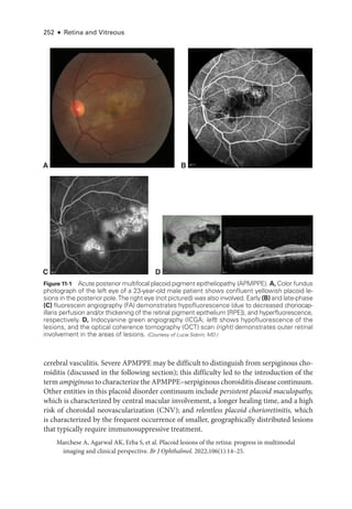 252 ● Retina and Vitreous
ce­
re­
bral vasculitis. Severe APMPPE may be difficult to distinguish from serpiginous cho-
roiditis (discussed in the following section); this difficulty led to the introduction of the
term ampiginous to characterize the APMPPE–­serpiginous choroiditis disease continuum.
Other entities in this placoid disorder continuum include per­sis­tent placoid maculopathy,
which is characterized by central macular involvement, a longer healing time, and a high
risk of choroidal neovascularization (CNV); and relentless placoid chorioretinitis, which
is characterized by the frequent occurrence of smaller, geo­
graph­
i­
cally distributed lesions
that typically require immunosuppressive treatment.
Marchese A, Agarwal AK, Erba S, et al. Placoid lesions of the ret­
i­
na: pro­
gress in multimodal
imaging and clinical perspective. Br J Ophthalmol. 2022;106(1):14–25.
B
A
C D
Figure 11-1 Acute posterior multifocal placoid pigment epitheliopathy (APMPPE). A, Color ­fundus
photo­
graph of the left eye of a 23-­
year-­
old male patient shows confluent yellowish placoid le-
sions in the posterior pole.The right eye (not pictured) was also involved. Early (B) and late-­
phase
(C) fluorescein angiography (FA) demonstrates hypofluorescence (due to decreased choriocap-
illaris perfusion and/or thickening of the ret­
i­
nal pigment epithelium [RPE]), and hyperfluorescence,
respectively. D, Indocyanine green angiography (ICGA; left) shows hypofluorescence of the
lesions, and the optical coherence tomography (OCT) scan (right) demonstrates outer ret­
i­
nal
involvement in the areas of lesions. (Courtesy of Lucia Sobrin, MD.)
 