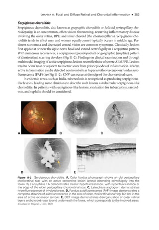 Chapter 11: Focal and Diffuse Ret­
i­
nal and Choroidal Inflammation ● 253
Serpiginous choroiditis
Serpiginous choroiditis, also known as geographic choroiditis or helicoid peripapillary cho-
roidopathy, is an uncommon, often vision-­
threatening, recurring inflammatory disease
involving the outer ret­
ina, RPE, and inner choroid (the choriocapillaris). Serpiginous cho-
roiditis tends to affect men and ­
women equally; onset typically occurs in ­
middle age. Per­
sis­
tent scotomata and decreased central vision are common symptoms. Classically, lesions
first appear at or near the optic nerve head and extend centrifugally in a serpentine pattern.
With numerous recurrences, a serpiginous (pseudopodial) or geographic (maplike) pattern
of chorioret­
i­
nal scarring develops (Fig 11-2). Findings on clinical examination and through
multimodal imaging of active serpiginous lesions resemble ­
those of severe APMPPE. Lesions
tend to occur near or adjacent to inactive scars from prior episodes of inflammation. Recent,
active inflammation can be detected noninvasively as hyperautofluorescence on fundus auto­
fluorescence (FAF) (see Fig 11-2). CNV can occur at the edge of the chorioret­
i­
nal scars.
In endemic areas, such as India, tuberculosis is recognized as producing serpiginous-­
like lesions, leading some clinicians to describe such lesions as tubercular serpiginous-­like
choroiditis. In patients with serpiginous-­
like lesions, evaluation for tuberculosis, sarcoid-
osis, and syphilis should be considered.
B
A C
D E
Figure 11-2 Serpiginous choroiditis. A, Color fundus photo­
graph shows an old peripapillary
chorioret­
i­
nal scar with an active serpentine lesion (arrow) extending centrifugally into the
fovea. B, Early-­
phase FA demonstrates classic hypofluorescence, with hyperfluorescence of
the edge of the older peripapillary chorioret­
i­
nal scar. C, Late-­
phase angiogram demonstrates
hyperfluorescence of involved areas. D, Fundus autofluorescence (FAF) image demonstrates a
complete absence of autofluorescence in the area of older chorioret­
i­
nal scarring, but not in the
area of active extension (arrow). E, OCT image demonstrates disor­
ga­
ni­
za­
tion of outer ret­
i­
nal
layers and choroid nasal to and under­
neath the fovea, which corresponds to the involved areas.
(Courtesy of Stephen J. Kim, MD.)
 