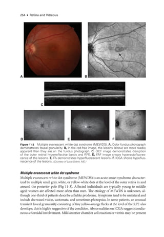254 ● Retina and Vitreous
Multiple evanescent white dot syndrome
Multiple evanescent white dot syndrome (MEWDS) is an acute-­
onset syndrome character-
ized by multiple small gray, white, or yellow-­
white dots at the level of the outer ret­
ina in and
around the posterior pole (Fig 11-3). Affected individuals are typically young to ­
middle
aged; ­
women are affected more often than men. The etiology of MEWDS is unknown, al-
though one-­
third of patients describe a flulike prodrome. Symptoms tend to be unilateral and
include decreased vision, scotomata, and sometimes photopsias. In some patients, an unusual
transient foveal granularity consisting of tiny yellow-­
orange flecks at the level of the RPE also
develops; this is highly suggestive of the condition. Abnormalities on ICGA suggest simulta-
neous choroidal involvement. Mild anterior chamber cell reaction or vitritis may be pre­
sent
A B
C
E
D F
Figure 11-3 Multiple evanescent white dot syndrome (MEWDS). A, Color fundus photo­
graph
demonstrates foveal granularity. B, In the red-­
free image, the lesions (arrow) are more readily
apparent than they are on the fundus photo­
graph. C, OCT image demonstrates disruption
of the outer ret­
i­
nal hyperreflective bands and RPE. D, FAF image shows hyperautofluores-
cence of the lesions. E, FA demonstrates hyperfluorescent lesions. F, ICGA shows hypofluo-
rescence of the lesions. (Courtesy of Lucia Sobrin, MD.)
 
