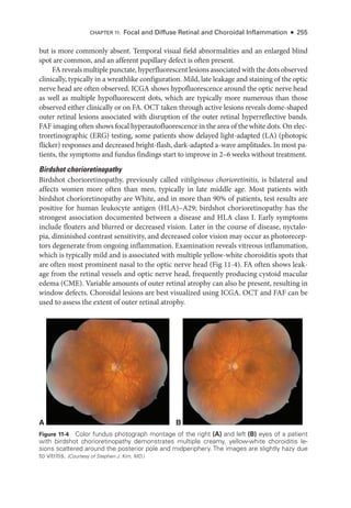 Chapter 11: Focal and Diffuse Ret­
i­
nal and Choroidal Inflammation ● 255
but is more commonly absent. Temporal visual field abnormalities and an enlarged blind
spot are common, and an afferent pupillary defect is often pre­
sent.
FA reveals multiple punctate, hyperfluorescent lesions associated with the dots observed
clinically, typically in a wreathlike configuration. Mild, late leakage and staining of the optic
nerve head are often observed. ICGA shows hypofluorescence around the optic nerve head
as well as multiple hypofluorescent dots, which are typically more numerous than ­
those
observed ­
either clinically or on FA. OCT taken through active lesions reveals dome-­
shaped
outer ret­
i­
nal lesions associated with disruption of the outer ret­
i­
nal hyperreflective bands.
FAF imaging often shows focal hyperautofluorescence in the area of the white dots. On elec-
troretinographic (ERG) testing, some patients show delayed light-­
adapted (LA) (photopic
flicker) responses and decreased bright-­
flash, dark-­
adapted a-­
wave amplitudes. In most pa-
tients, the symptoms and fundus findings start to improve in 2–6 weeks without treatment.
Birdshot chorioretinopathy
Birdshot chorioretinopathy, previously called vitiliginous chorioretinitis, is bilateral and
affects ­
women more often than men, typically in late ­
middle age. Most patients with
birdshot chorioretinopathy are White, and in more than 90% of patients, test results are
positive for ­
human leukocyte antigen (HLA)–­
A29; birdshot chorioretinopathy has the
strongest association documented between a disease and HLA class I. Early symptoms
include floaters and blurred or decreased vision. ­
Later in the course of disease, nyctalo-
pia, diminished contrast sensitivity, and decreased color vision may occur as photorecep-
tors degenerate from ongoing inflammation. Examination reveals vitreous inflammation,
which is typically mild and is associated with multiple yellow-­
white choroiditis spots that
are often most prominent nasal to the optic nerve head (Fig 11-4). FA often shows leak-
age from the ret­
i­
nal vessels and optic nerve head, frequently producing cystoid macular
edema (CME). Variable amounts of outer ret­
i­
nal atrophy can also be pre­
sent, resulting in
win­
dow defects. Choroidal lesions are best visualized using ICGA. OCT and FAF can be
used to assess the extent of outer ret­
i­
nal atrophy.
A B
Figure 11-4 Color fundus photo­
graph montage of the right (A) and left (B) eyes of a patient
with birdshot chorioretinopathy demonstrates multiple creamy, yellow-­
white choroiditis le-
sions scattered around the posterior pole and midperiphery. The images are slightly hazy due
to vitritis. (Courtesy of Stephen J. Kim, MD.)
 
