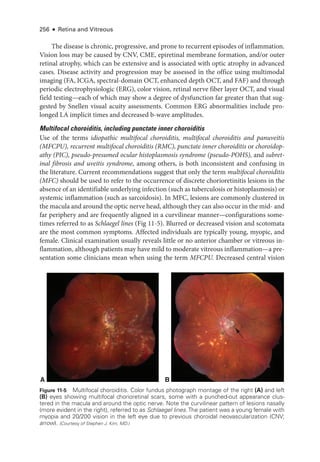 256 ● Retina and Vitreous
The disease is chronic, progressive, and prone to recurrent episodes of inflammation.
Vision loss may be caused by CNV, CME, epiret­
i­
nal membrane formation, and/or outer
ret­
i­
nal atrophy, which can be extensive and is associated with optic atrophy in advanced
cases. Disease activity and progression may be assessed in the office using multimodal
imaging (FA, ICGA, spectral-­
domain OCT, enhanced depth OCT, and FAF) and through
periodic electrophysiologic (ERG), color vision, ret­
i­
nal nerve fiber layer OCT, and visual
field testing—­
each of which may show a degree of dysfunction far greater than that sug-
gested by Snellen visual acuity assessments. Common ERG abnormalities include pro-
longed LA implicit times and decreased b-­
wave amplitudes.
Multifocal choroiditis, including punctate inner choroiditis
Use of the terms idiopathic multifocal choroiditis, multifocal choroiditis and panuveitis
(MFCPU), recurrent multifocal choroiditis (RMC), punctate inner choroiditis or choroidop-
athy (PIC), pseudo-­
presumed ocular histoplasmosis syndrome (pseudo-­
POHS), and subret­
i­
nal fibrosis and uveitis syndrome, among ­
others, is both inconsistent and confusing in
the lit­
er­
a­
ture. Current recommendations suggest that only the term multifocal choroiditis
(MFC) should be used to refer to the occurrence of discrete chorioretinitis lesions in the
absence of an identifiable under­
lying infection (such as tuberculosis or histoplasmosis) or
systemic inflammation (such as sarcoidosis). In MFC, lesions are commonly clustered in
the macula and around the optic nerve head, although they can also occur in the mid-­and
far periphery and are frequently aligned in a curvilinear manner—­
configurations some-
times referred to as Schlaegel lines (Fig 11-5). Blurred or decreased vision and scotomata
are the most common symptoms. Affected individuals are typically young, myopic, and
female. Clinical examination usually reveals ­
little or no anterior chamber or vitreous in-
flammation, although patients may have mild to moderate vitreous inflammation—­
a pre­
sen­
ta­
tion some clinicians mean when using the term MFCPU. Decreased central vision
A B
Figure 11-5 Multifocal choroiditis. Color fundus photo­
graph montage of the right (A) and left
(B) eyes showing multifocal chorioret­
i­
nal scars, some with a punched-­
out appearance clus-
tered in the macula and around the optic nerve. Note the curvilinear pattern of lesions nasally
(more evident in the right), referred to as Schlaegel lines.The patient was a young female with
myopia and 20/200 vision in the left eye due to previous choroidal neovascularization (CNV;
arrow). (Courtesy of Stephen J. Kim, MD.)
 