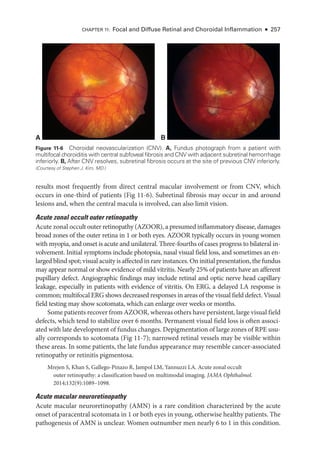 Chapter 11: Focal and Diffuse Ret­
i­
nal and Choroidal Inflammation ● 257
results most frequently from direct central macular involvement or from CNV, which
occurs in one-­
third of patients (Fig 11-6). Subret­
i­
nal fibrosis may occur in and around
lesions and, when the central macula is involved, can also limit vision.
Acute zonal occult outer retinopathy
Acute zonal occult outer retinopathy (AZOOR), a presumed inflammatory disease, damages
broad zones of the outer ret­
ina in 1 or both eyes. AZOOR typically occurs in young ­
women
with myopia, and onset is acute and unilateral. Three-­
fourths of cases pro­
gress to bilateral in-
volvement. Initial symptoms include photopsia, nasal visual field loss, and sometimes an en-
larged blind spot; visual acuity is affected in rare instances. On initial pre­sen­ta­tion, the fundus
may appear normal or show evidence of mild vitritis. Nearly 25% of patients have an afferent
pupillary defect. Angiographic findings may include ret­
i­
nal and optic nerve head capillary
leakage, especially in patients with evidence of vitritis. On ERG, a delayed LA response is
common; multifocal ERG shows decreased responses in areas of the visual field defect. Visual
field testing may show scotomata, which can enlarge over weeks or months.
Some patients recover from AZOOR, whereas ­others have per­sis­tent, large visual field
defects, which tend to stabilize over 6 months. Permanent visual field loss is often associ-
ated with late development of fundus changes. Depigmentation of large zones of RPE usu-
ally corresponds to scotomata (Fig 11-7); narrowed ret­
i­
nal vessels may be vis­
i­
ble within
­
these areas. In some patients, the late fundus appearance may resemble cancer-­
associated
retinopathy or retinitis pigmentosa.
Mrejen S, Khan S, Gallego-­
Pinazo R, Jampol LM, Yannuzzi LA. Acute zonal occult
outer retinopathy: a classification based on multimodal imaging. JAMA Ophthalmol.
2014;132(9):1089–1098.
Acute macular neuroretinopathy
Acute macular neuroretinopathy (AMN) is a rare condition characterized by the acute
onset of paracentral scotomata in 1 or both eyes in young, other­
wise healthy patients. The
pathogenesis of AMN is unclear. ­
Women outnumber men nearly 6 to 1 in this condition.
A B
Figure 11-6 Choroidal neovascularization (CNV). A, Fundus photo­
graph from a patient with
multifocal choroiditis with central subfoveal fibrosis and CNV with adjacent subret­
i­
nal hem­
orrhage
inferiorly. B, ­
After CNV resolves, subret­
i­
nal fibrosis occurs at the site of previous CNV inferiorly.
(Courtesy of Stephen J. Kim, MD.)
 